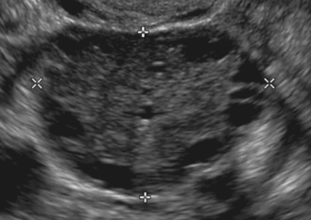 다낭성 난소증후군 환자의 난소 초음파 이미지, 작은 난포들이 다수 관찰됨