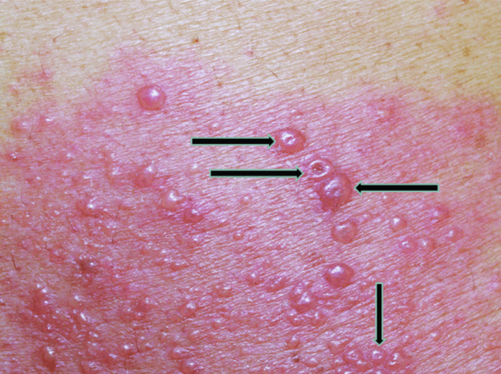 재발성 헤르페스 단순 바이러스 감염의 전형적인 증상인 군집된 수포(물집) 이미지