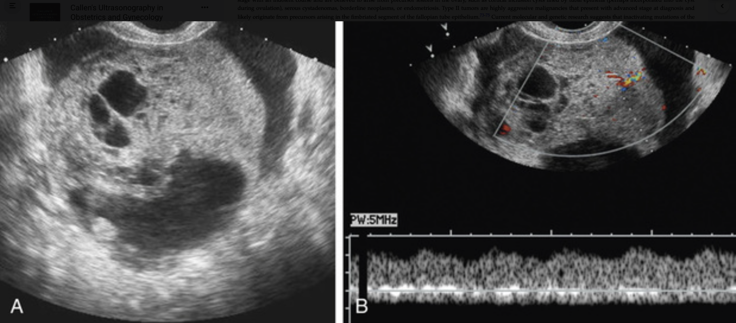 난소 투명세포 낭선암의 초음파 소견으로 큰 고형 성분과 내부 혈류가 관찰되는 낭성 및 고형성 혼재 종괴